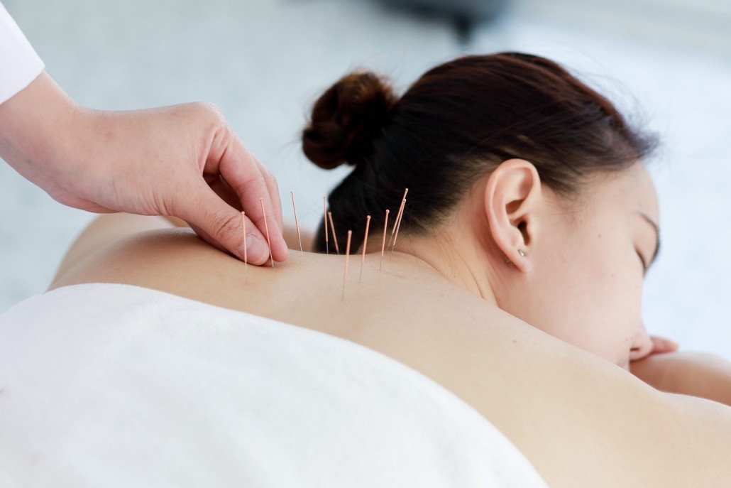 Acupuncture: A Thing for the Healthy Person?