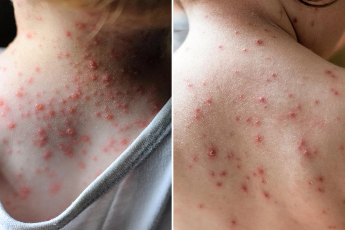 Chickenpox Explained: Symptoms, Causes, Treatment &amp; Prevention
