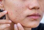 Acne Cure for Sure!  
