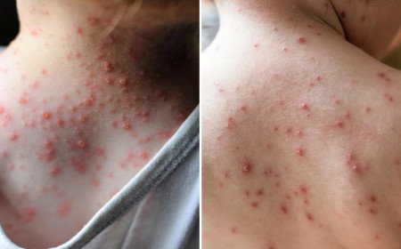 Chickenpox Explained: Symptoms, Causes, Treatment &amp; Prevention