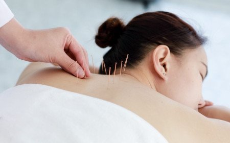 Acupuncture: A Thing for the Healthy Person?