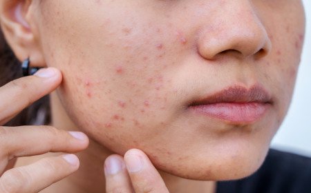 Acne Cure for Sure!  