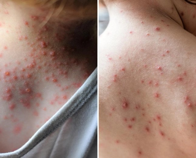 Chickenpox Explained: Symptoms, Causes, Treatment &amp; Prevention