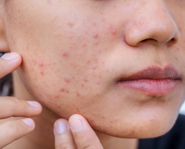 Acne Cure for Sure!  